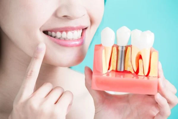 cấy ghép implant t-smile