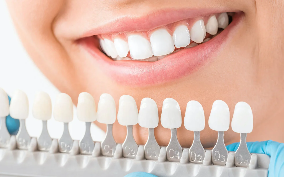 dịch vụ dán mặt sứ răng