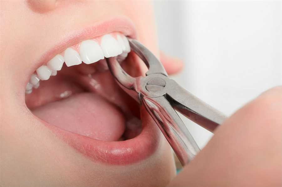 Dịch vụ nhổ răng